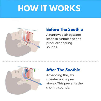 The Soothie Anti Snoring Mouthpiece