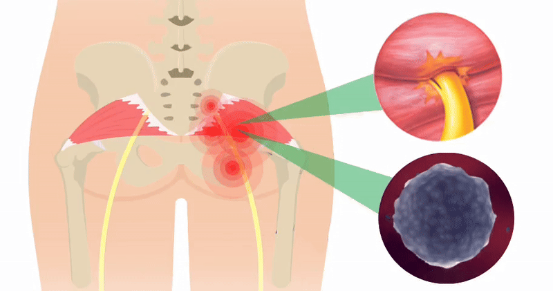 SciatiEase - Supports Sciatic Nerve Health